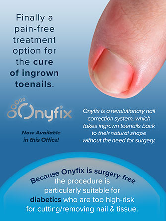onyfix for ingrown toenails