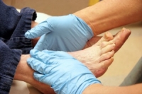 Ways Diabetes Affects the Feet