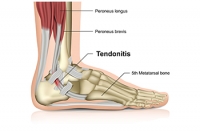 Two Types of Achilles Tendon Injuries